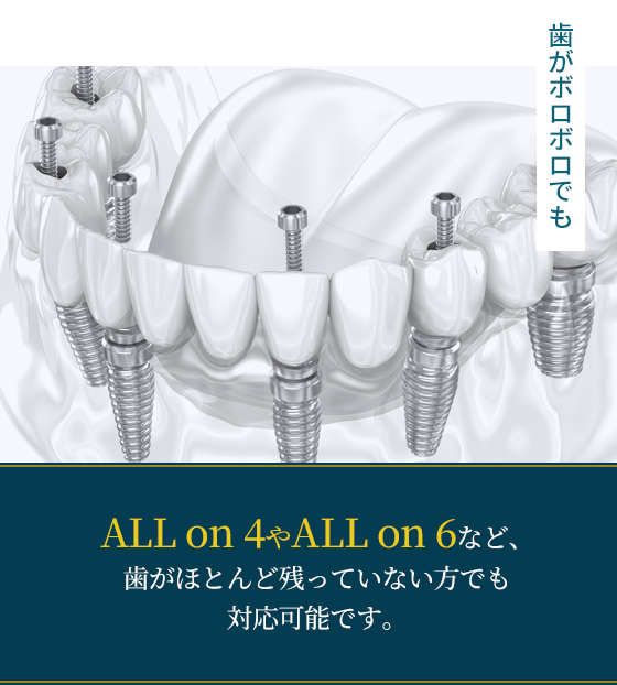 歯がボロボロでもALLon4やALLon6など、歯がほとんど残っていない方でも対応可能です。